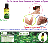 Tea Tree Oil for Eczema - Natural Essential Oils - Natural Herbs Clinic