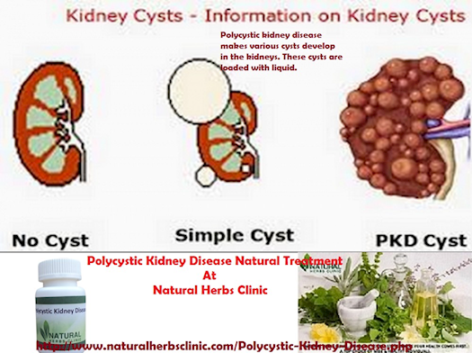 Polycystic Kidney Disease Natural Treatment