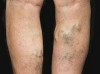 Varicose Veins Are A Real Risk To Your Health