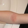 Eczema before Soothe