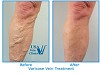 Laser Varicose Vein Treatments by USA Vein Clinics 