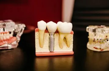 Find the Dental Implants Cost - Dental Costs Australia