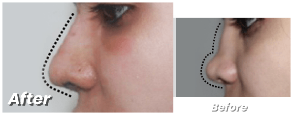 Best Rhinoplasty surgeon in Lahore
