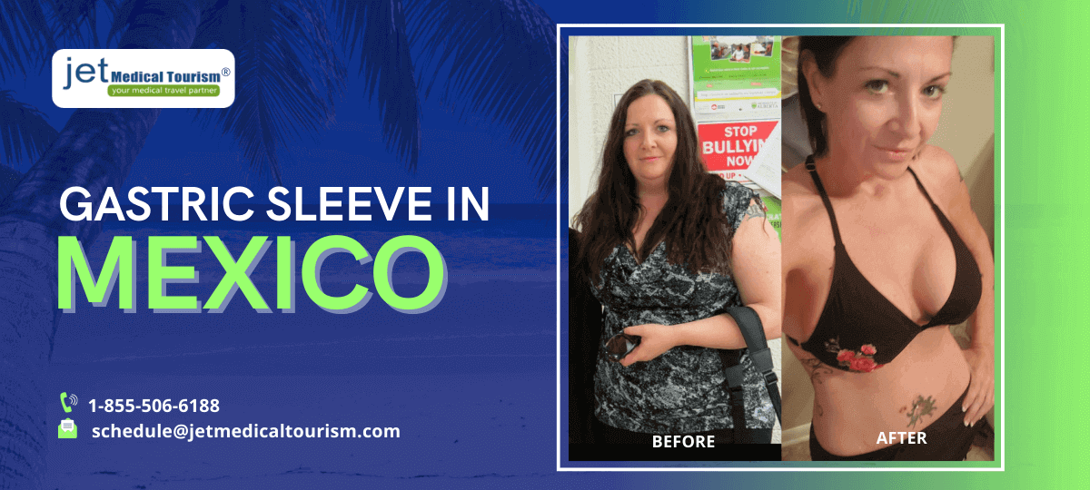 Gastric sleeve Mexico