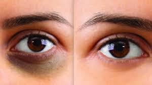 Dark Under Eyes Treatment San Diego