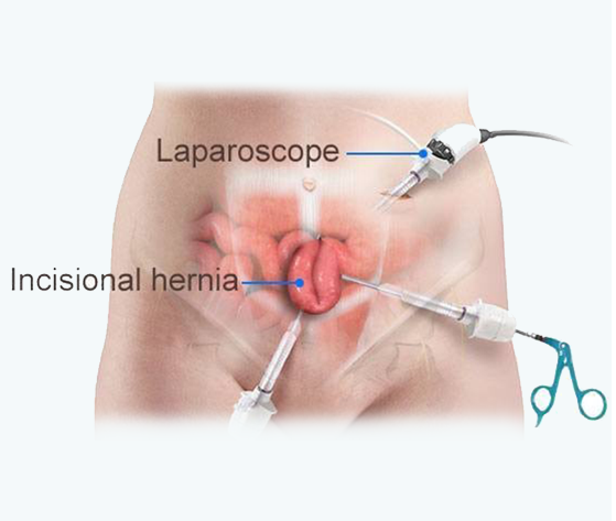 hernia mesh price in pakistan