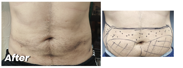 Liposuction in Pakistan cost