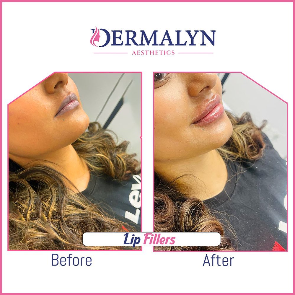 Lip Fillers in Delhi
