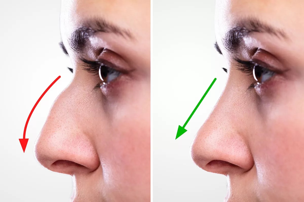 Best Rhinoplasty surgeon in Lahore