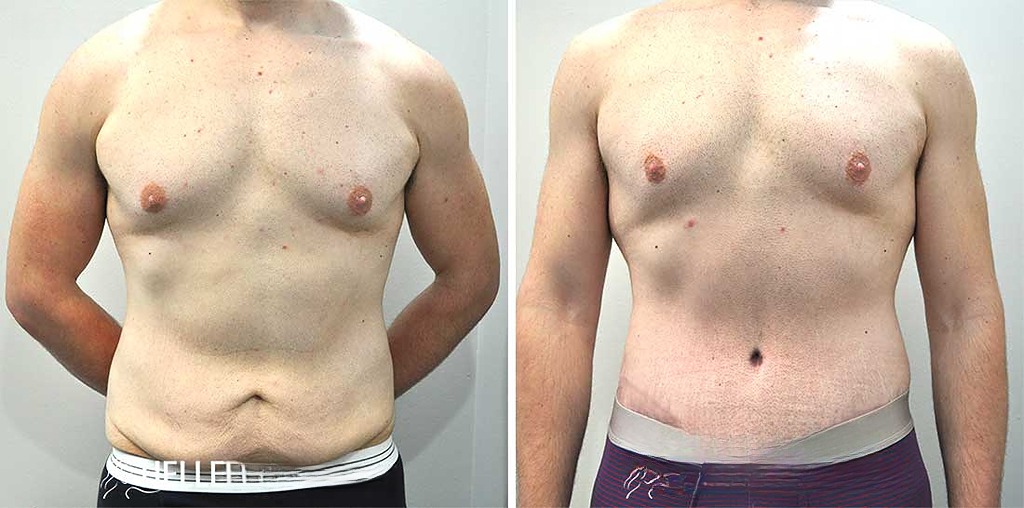tummy tuck surgery in Lahore