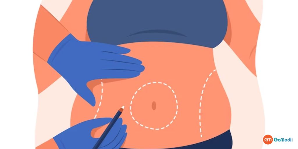 Get Gastric Bypass Surgery in India with Gomedii