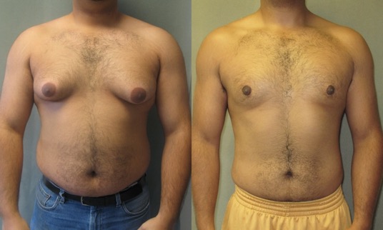Gynecomastia surgery in Lahore 