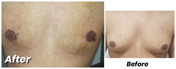 Gynecomastia surgery cost in Lahore