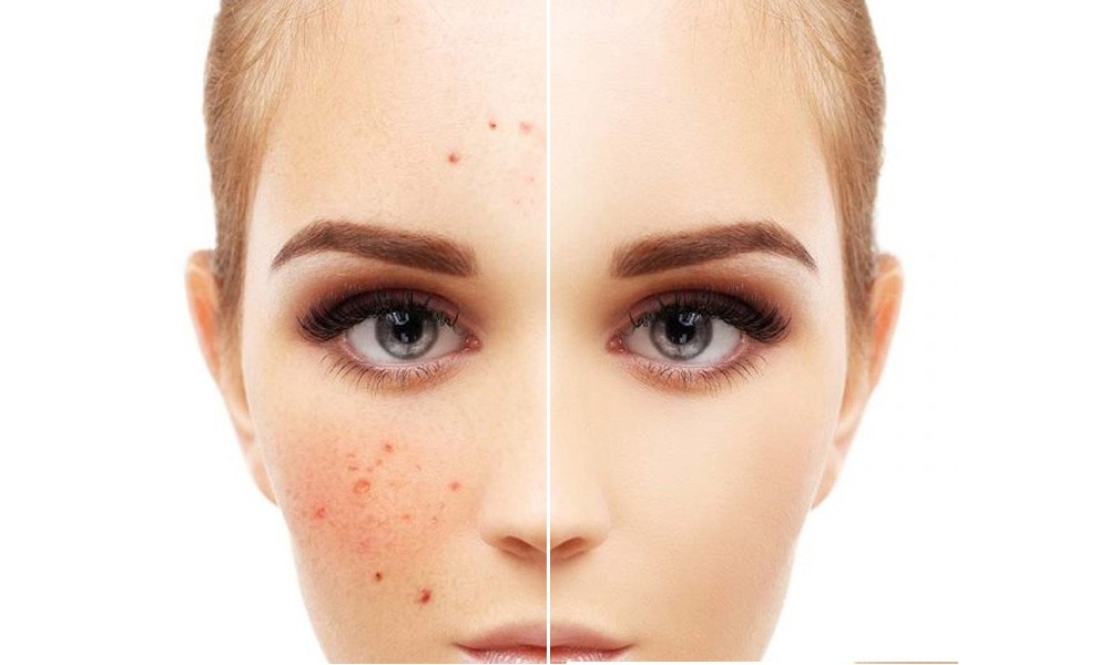 Ayurvedic Treatment for Pigmentation
