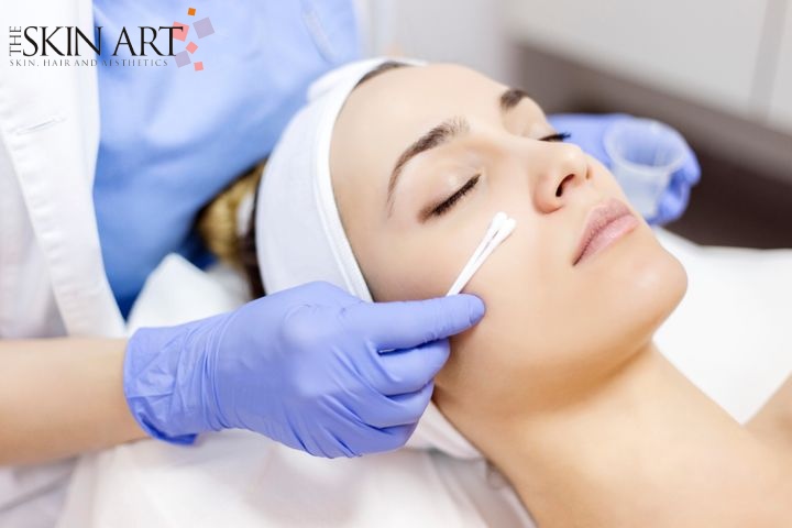 Best Chemical Peel Treatment in Lucknow