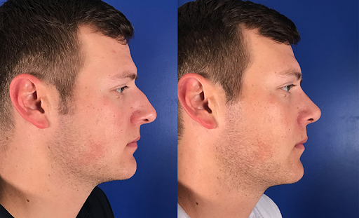 Cilento Facial Plastics: Your Solution to Nasal Imperfections in Houston