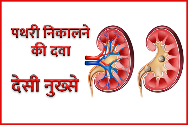 How to Remove Kidney Stone in Ayurvedic Way