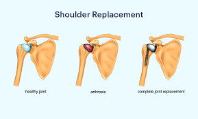 Shoulder Replacement Surgery in India Logo