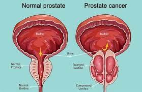 Prostate Cancer Treatment Cost in India Logo