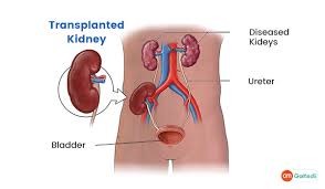 What is Kidney Transplant Cost in India Logo