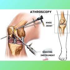 Arthroscopic Surgery Cost in India Logo