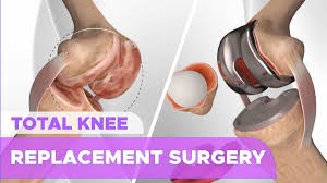 Knee Replacement Surgery India Logo