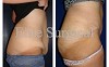 Tummy Tuck Surgery at Elite Surgical