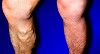 Know how to improve varicose veins