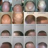 Everything You need to Know about Neograft Hair Transplants