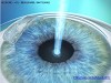 Lasik Laser Eye Surgery 