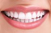High Quality Teeth whitening in Delhi - Smile Delhi