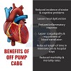 BENEFITS OF OFF PUMP CABG
