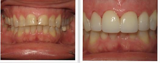 Before and After Photos of Porcelain Crowns