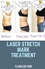 Laser Stretch Mark Treatment Now In Your City Miami