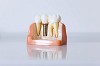 Best Dental Implant Treatment In Bangalore– MyDentist Dental Clinic for Complete Dental Solution.