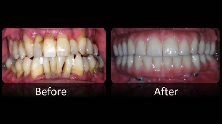 Dental Implants Nashua NH