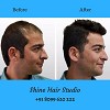 Non surgical Hair Replacement