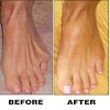 Bunion: Before and After