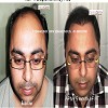 hair transplant