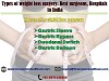 Types of weight loss surgery Best surgeons, Hospitals in India