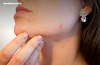 Acne Treatments | Ireland's Best Acne Treatment | TheSkinNurse.ie