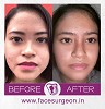 Nose Plastic Surgery In India | Richardsons Dental Hospital