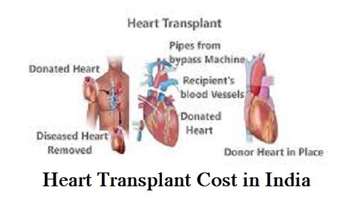 Heart Transplant Cost