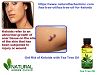 Tea Tree Oil for Keloids - Natural Essential Oils - Natural Herbs Clinic