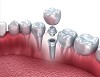 Best Dental Implants in Delhi - Smile Delhi The Dental Clinic