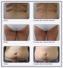 Coolsculpting Melbourne | Fat Reduction | Fat Freezing | Nitai Medical & Cosmetic Centre