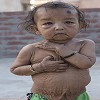 18 month old Baby suffering from Skin Disease