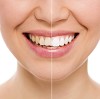 Teeth Whitening Service in Burlington - Desired Smiles				