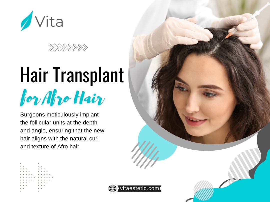 Hair Transplant for Afro Hair