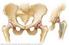  Hip Replacement Surgery Cost in India